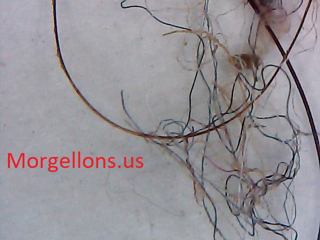 Morgellons Disease The Silent Pandemic – fibromyalgia, Shingles, Lyme & Eczema –  Undecylenic Acid