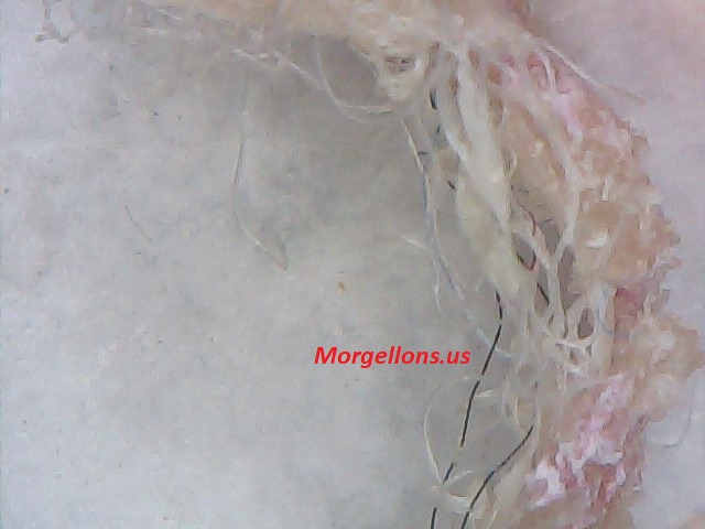 COVID 19 Is morgellons Disease: The Silent Pandemic, Doctors and scientist ignore it Aspergillus Fumigatus Is Morgellons Disease: The Silent Pandemic